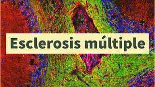 Esclerosis múltiple diagnóstico síntomas tratamiento y pronóstico pérdida de mielina [upl. by Rauch]