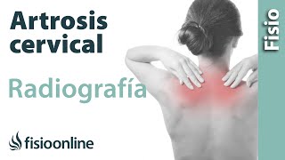 Artrosis cervical  Qué es y cómo se diagnostica en radiografías [upl. by Strep865]