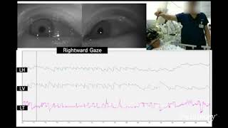 Upbeat and horizontal gazeevoked nystagmus in bilateral medial medullary infarction [upl. by Templa]