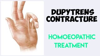 Dupuytrens contracture homeopathic treatment डुपायट्रेन्स कॉन्ट्रेक्चर का होम्योपैथिक ईलाज [upl. by Gildas752]