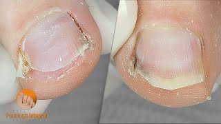 I dont stop cleaning the nail groove until the patient is relieved Podología Integral [upl. by Twelve]