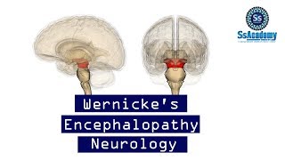 MRCP Best Lecture On  Wernickes Encephalopathy Neurology [upl. by Enia]