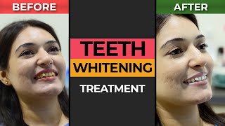 Teeth Whitening Treatment at Hash Clinics [upl. by Mohn]