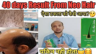 Very Fast Result from Neo Hair Lotion In Just 40 Days इसका बाल आने का कोइ उम्मीद नही था🤔 [upl. by Kuo]