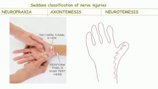 Seddons classification of nerve injurybackbenchers revolution [upl. by Aihcrop]