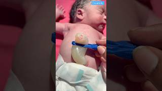 How Big Umbilical Cordmedical newbornbaby viralvideo [upl. by Sweet]