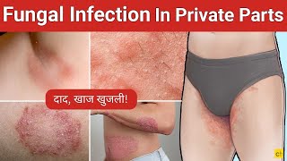 Fungal Infection छुटकारा पाने के लिए आजमाएं ये 5 पाउडर in Private Parts  Credihealth [upl. by Aihsercal]