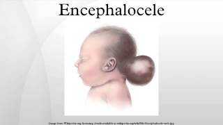 Encephalocele [upl. by Tamarah]