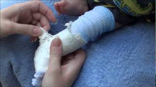 How to remove a fiberglass and plaster cast from an infant [upl. by Ulphi]