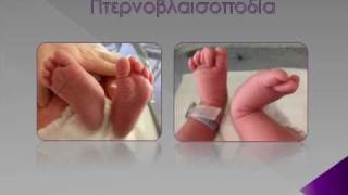 ORTHOPAEDIC NEWBORN CONDITIONS ΟΡΘΟΠΑΙΔΙΚΕΣ ΠΑΘΗΣΕΙΣ ΣΤΑ ΝΕΟΓΝΑ [upl. by Euqinaj994]