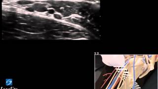 3D Lehrvideo Ultraschallgestützte Axilläre regionale Nervenblockade  SonoSite Ultraschall [upl. by Branden]