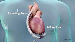 Heart Mate 3 LVAD [upl. by Ihab]