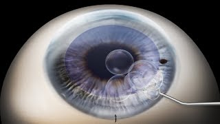 DMEK Descemets membrane endothelial keratoplasty animation [upl. by Neelear965]