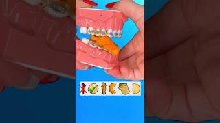 3 CHIPS to AVOID with BRACES what to eat instead braces chips takis [upl. by Yraek]