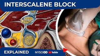 UltrasoundGuided Continuous Interscalene Brachial Plexus Block  Regional Anesthesia [upl. by Anniala]