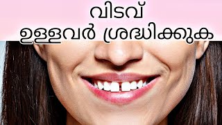 pallil vidavu mattan vazhikal  Braces  pallil kambi idunnath malayalam  frenectomy pallil kambi [upl. by Nilra]