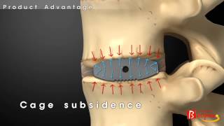 Bioflex Functional Cage SystemBiospine [upl. by Grindle]