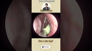 귀지형 콧물 부비동염 축농증 비염 코청소 이비인후과 rhinorrhea rhinitis sinusitis ASMR [upl. by Myer]