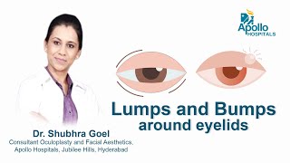 Lumps amp Bumps around Eyelids  Dr Shubhra Goel  Apollo Hospital [upl. by Lapham52]