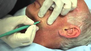 How to remove facial warts using Cautery [upl. by Akenahc]