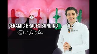 Step by step ceramic braces bonding Dentaurum by Dr amr Asker [upl. by Xilef]