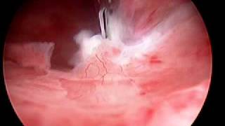 Hysteroscopic Morcellation of Myoma [upl. by Juliet163]