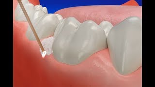 How Gum Disease Treatment Laser works [upl. by Phillips136]