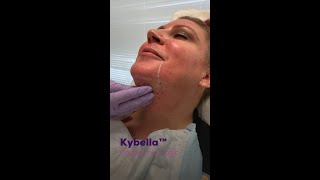 Kybella  Double Chin Treatment [upl. by Leonerd]