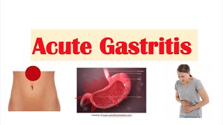 Acute Gastritis Stomach Inflammation  Causes Signs amp Symptoms Diagnosis Treatment [upl. by Maidy]