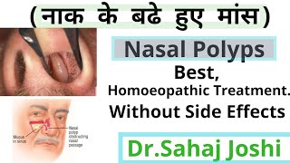 Homoeopathic Medicine For Nasal Polypsनाक के बढे हुए मांस [upl. by Mathis]