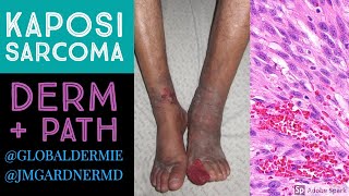 Kaposi Sarcoma DermatologyPathology Collaboration by globaldermie amp JMGardnerMD [upl. by Ecneralc981]