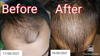 monoxide hair growth results after 3 months part3 [upl. by Lehar]