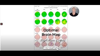 How to Interpret Your qEEG Brain Map [upl. by Zednanref]