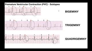 EKG Patterns  Premature Atrial amp Ventricular Contractions PACs amp PVCs [upl. by Chelton]