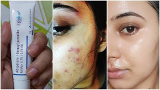 Benzoyl Peroxide to remove Pimples Acne Tiny Bumps Blackheads [upl. by Diley]