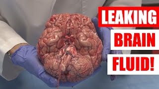 I am leaking Brain Fluid Medical Case Study with Ted [upl. by Eindys]