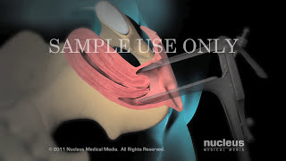 Hysteroscopy [upl. by Notsag]