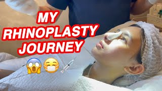 RHINOPLASTY JOURNEY [upl. by Cohby]