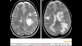 41 ADEM acute disseminated encephalomyelitis demyelination paediatric MOG AB post infectious [upl. by Griffin978]