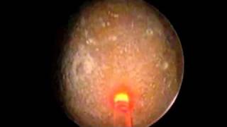 Vaporizzazione con laser ad olmio di voluminoso calcolo vescicale [upl. by Eerrehs]