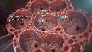 Idiopathic Pulmonary Fibrosis IPF Pathogenesis HD [upl. by Nettirb812]