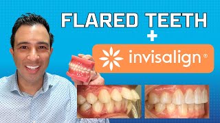 Invisalign Magic to Fix Flared Teeth WITHOUT EXTRACTION by Dr Robert Passamano [upl. by Trin]