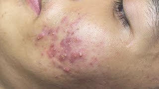 ACNE TREATMENT VU QUYNH MI  Perennial Blackheads On Boy Face 2024FULL [upl. by Liuqa]