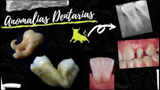 Anomalias Dentárias FusãoGeminaçãoTaurodontia etc [upl. by Nyvets382]