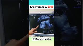 Twin Pregnancy Ultrasound Scan [upl. by Ardied]