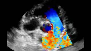 Estenosis pulmonar tipoA [upl. by Roee]