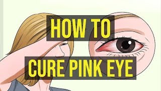 How To Cure Pink Eye Fast  5 Quick Ways [upl. by Luedtke169]