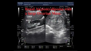 Renal Angiomyolipoma with a large Ovarian Mass [upl. by Aneeled]