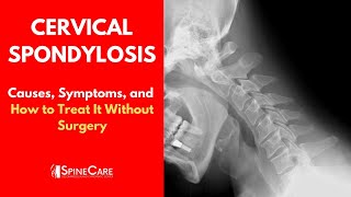 CERVICAL SPONDYLOSIS Causes Symptoms and Treatment NO SURGERY [upl. by Vanhomrigh]