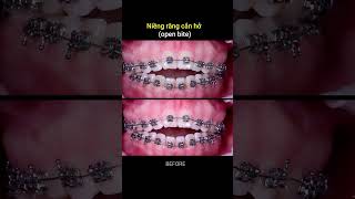 Braces process  deep bite open bite [upl. by Yerxa]